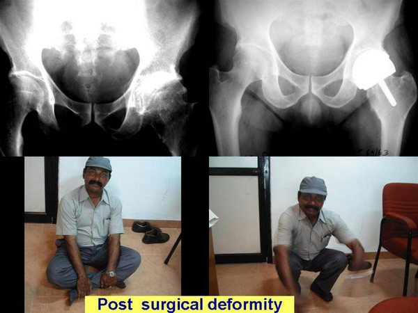 Hip Resurface Complex Cases - Post Surgical Deformity 