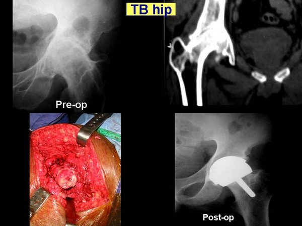Hip Resurface Complex Cases - T.B Hip 