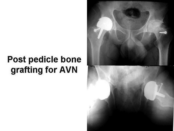 Post pedicle Bone Grafting for AVN