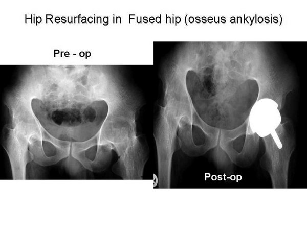 Hip Resurfacing in Fused Hip (osseus ankylosis) 