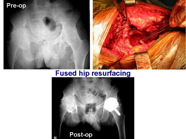 Hip Resurfacing Pre Op