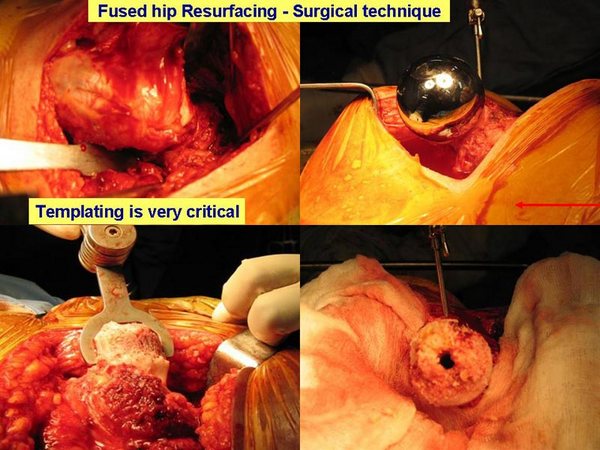 Fused Hip Resurfacing Surgical Technique