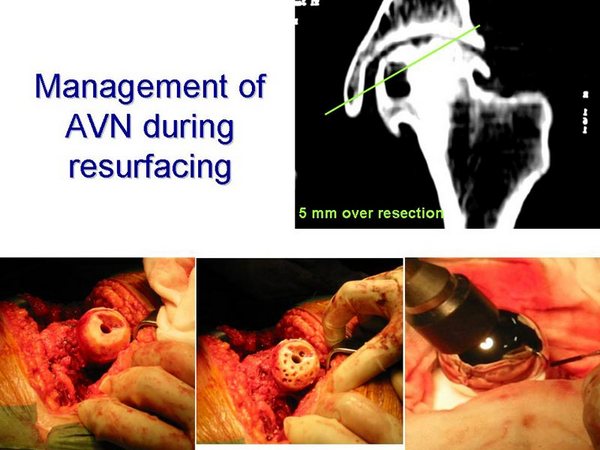 AVN - Management of AVN during Hip Resurfacing