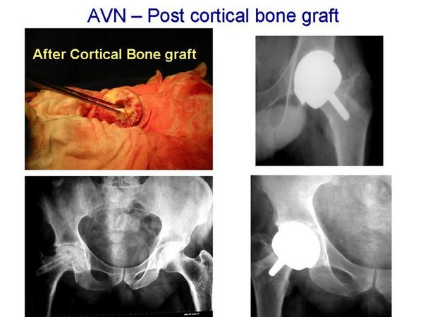 AVN - Post Cortical Bone Graft