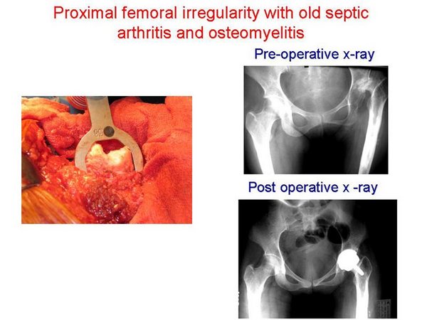 Proximal femoral irregularity with old septic arthritis and osteomyelitis
