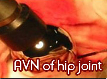 AVN Hip Joint Surgery