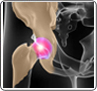 Osteotomy of the hip