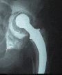 10 year old failed conventional Total Hip Replacement