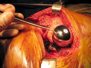 Dr.Vijay C. Bose Innovations in Birmingham Hip Resurfacing - NCP Approach Dr.Vijay C. Bose Innovations in Birmingham Hip Resurfacing - NCP Approach