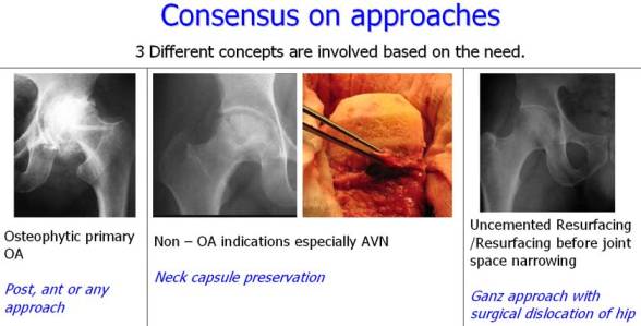 Consensus on approaches Consensus on approaches