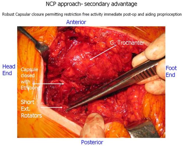 NCP approach- secondary advantage NCP approach- secondary advantage