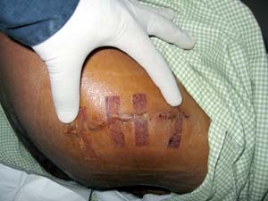 MIS-NCP BHR: Minimally invasive neck capsule preserving BHR MIS-NCP BHR: Minimally invasive neck capsule preserving BHR