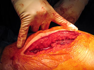 This minimally invasive is now offered for patients who do not have contraindications for the same.