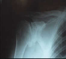 Shoulder Joint Replacement