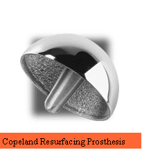 Copeland Resurfacing Prosthesis