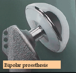 Bipolar prossthesis