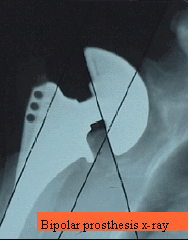 Bipolar prosthesis x-ray
