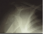 Shoulder Fractures