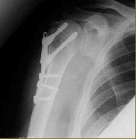 Shoulder Fractures