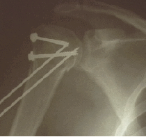 Shoulder Fractures