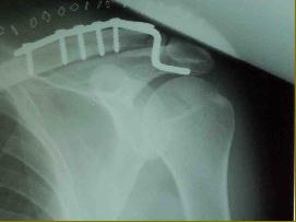 Shoulder Fractures