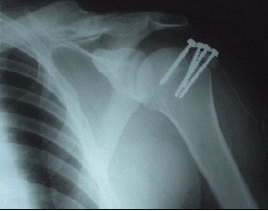 Shoulder Fractures Shoulder Fractures