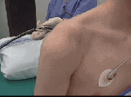 Recurrent Dislocation of Shoulder