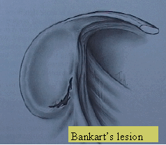 Bankart's lesion