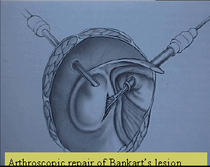 Arthroscopic repair of Bankart's lesion Arthroscopic repair of Bankart's lesion