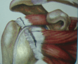 Rotator Cuff Tears 
