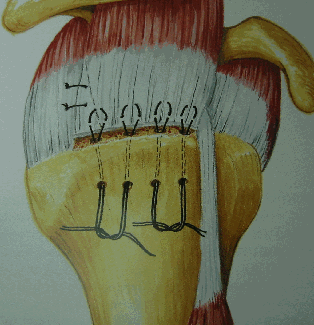 Rotator cuff repairs that can be done by the mini-open method