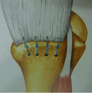 Rotator cuff repairs that can be done by the mini-open method