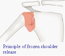 Principle of frozen shoulder release Principle of frozen shoulder release