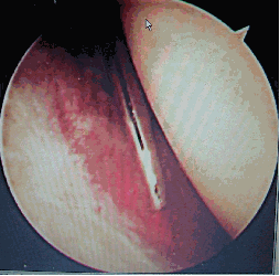 Arthroscopy pictures pre and post release of offending structures found in the rotator interval.