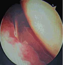 Arthroscopy pictures pre and post release of offending structures found in the rotator interval.