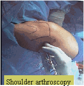 Shoulder arthroscopy Shoulder arthroscopy