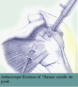Arthroscopic Excision of Chronic calcific de-posit.