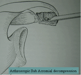 Arthroscopic Sub Acromial decompression