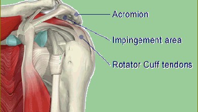 Painful Shoulder Conditions