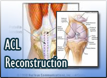 ACL Reconstruction
