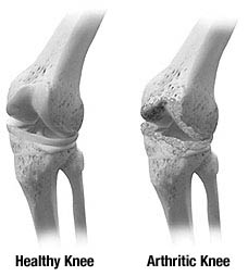 Rheumatoid Arthritis