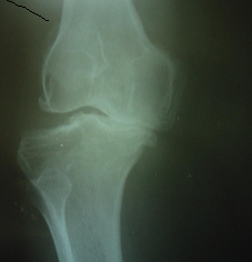 Rheumatoid Arthritis