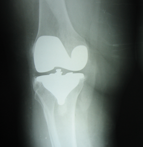 Revision Knee Replacement