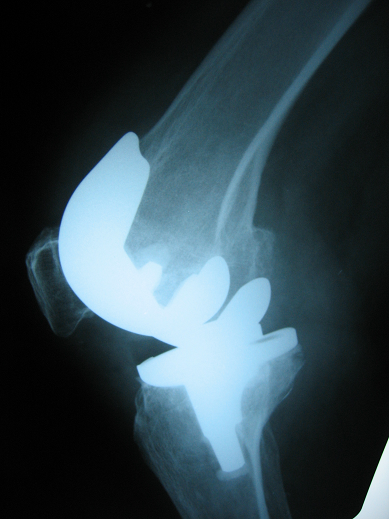 High Flex knee prosthesis High Flex knee prosthesis