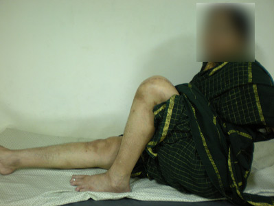 High Flex knee prosthesis