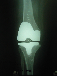  Mobile-Bearing Prosthesis