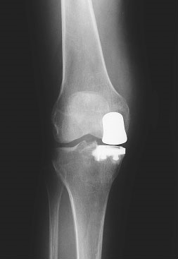 Total Knee Replacement Total Knee Replacement