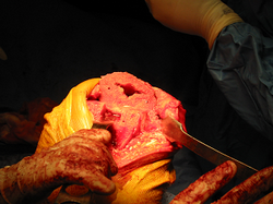 Knee Replacement Surgery Knee Replacement Surgery