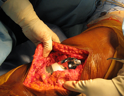 Knee Replacement Surgery Knee Replacement Surgery