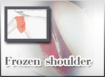 Frozen Shoulder